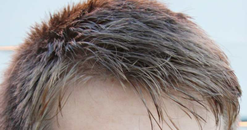 Haarausfall: Was tun, wenn die Haare ausfallen?